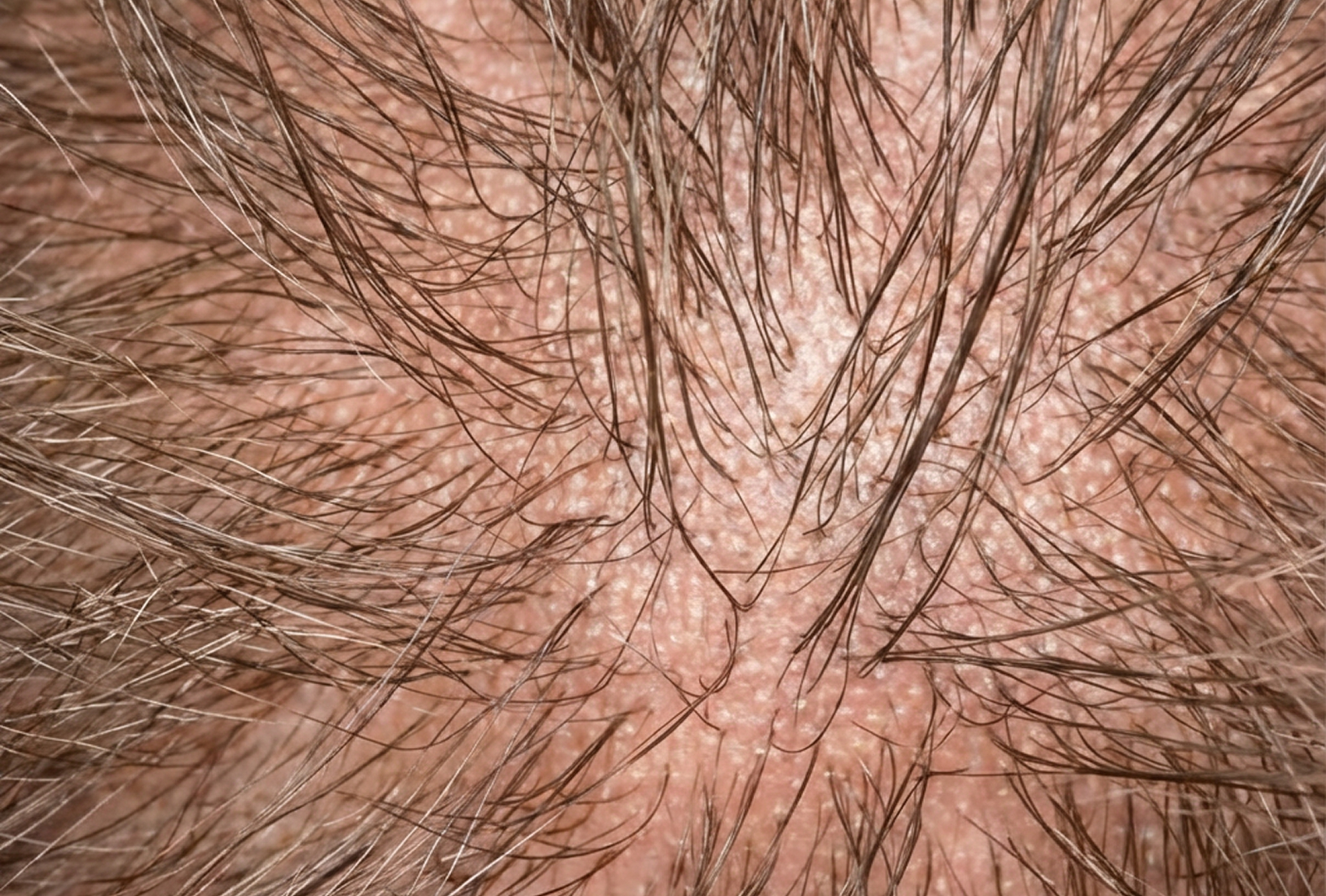 Диффузное истончение